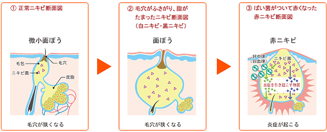 ニキビ断面図