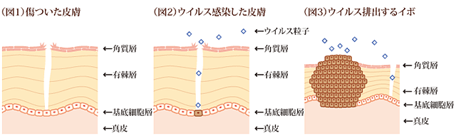 傷ついた皮膚　ウイルス感染した皮膚　ウイルス排出するイボ